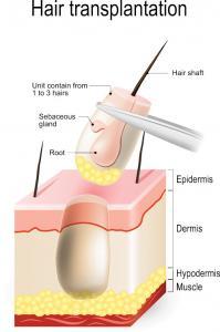 hair transplant diagram